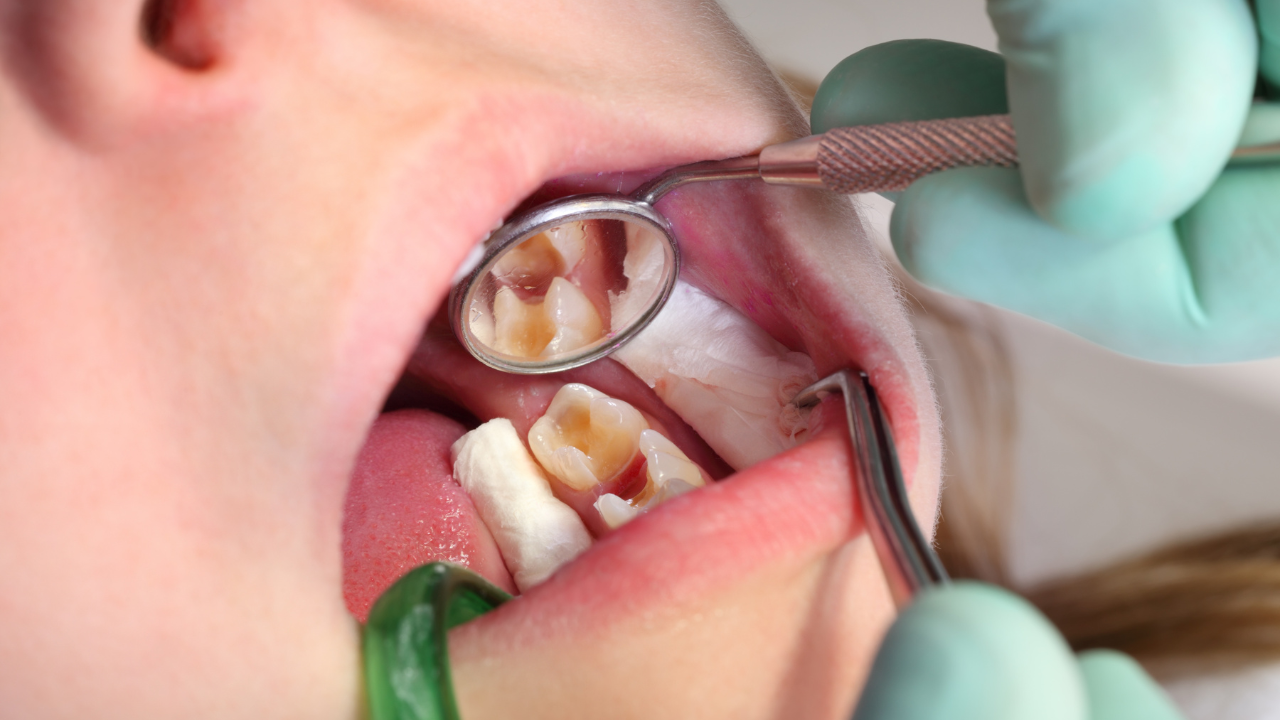 Bébé caries Bébé caries
